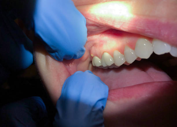 Best Dental Abscess Treatment in Belwood, NC